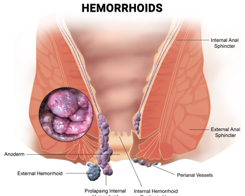 1470 nm HEMORRHOIDS