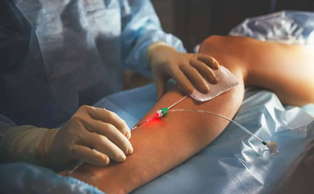 Endovenous Laser Treatment