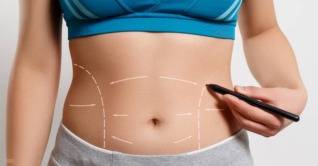 liposuction_plastic surgery
